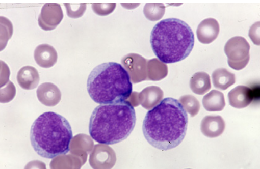 <p>which FAB classification is associated with the following information?</p><ul><li><p>&lt;5% of cases</p></li><li><p>infants or older patients&nbsp;</p></li></ul><p></p>