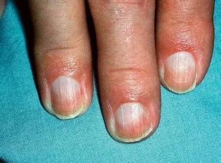 <p>half the nail is white</p><ul><li><p>indicates renal failure</p></li></ul>