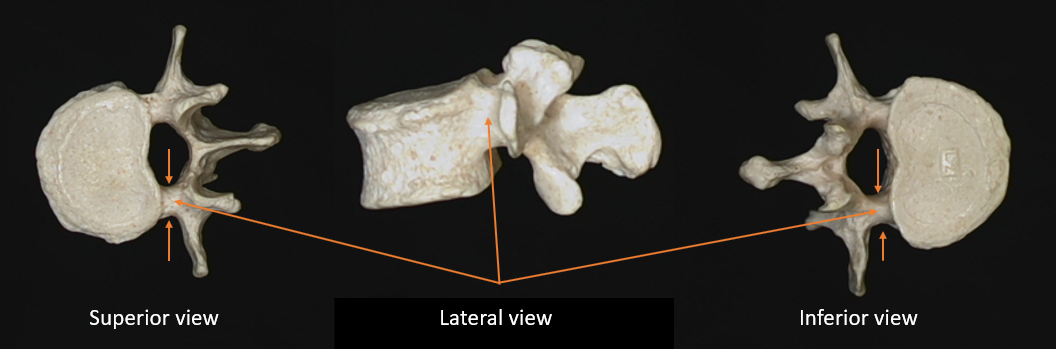 pedicle