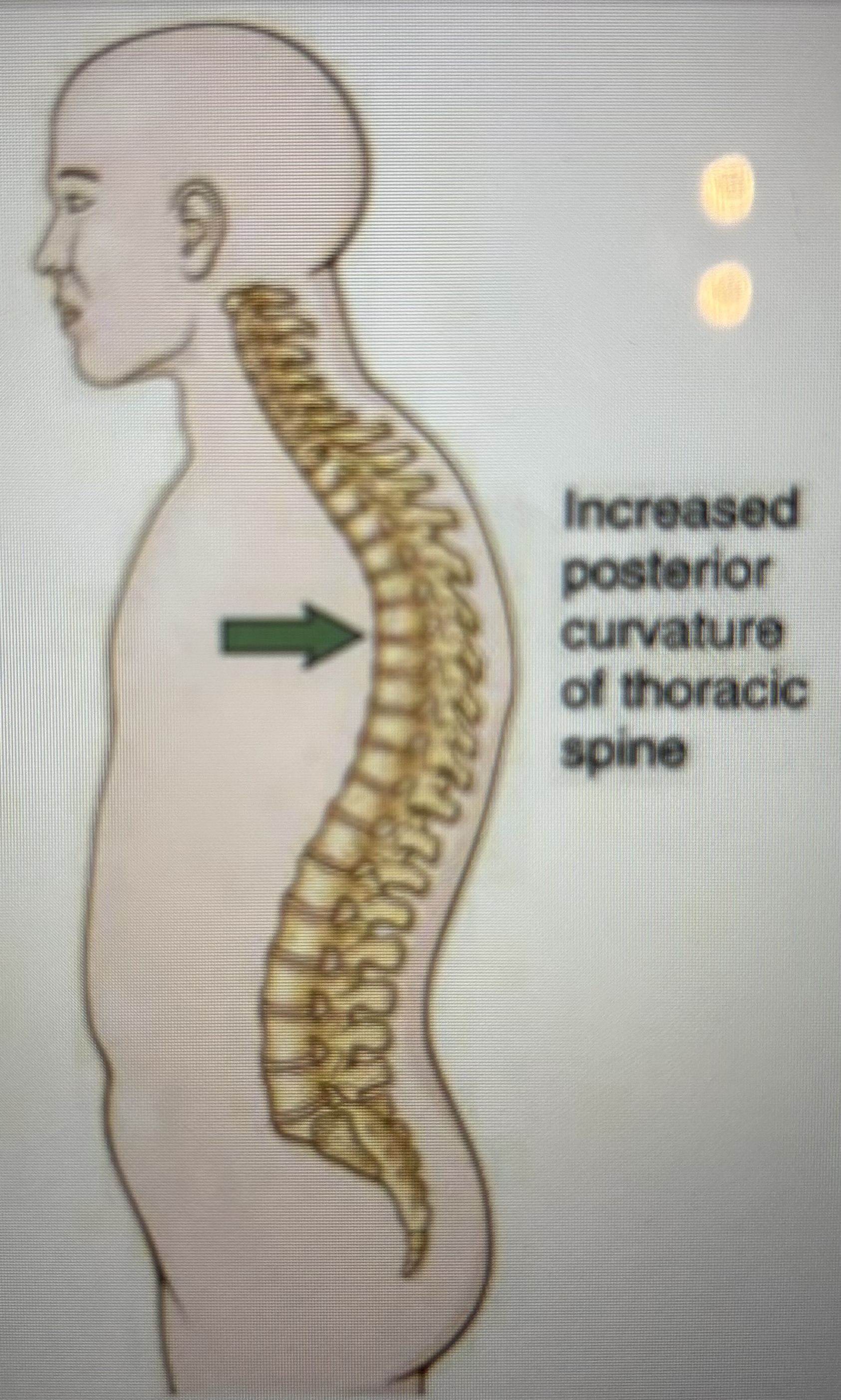 <p>What is this spinal curvature?</p>