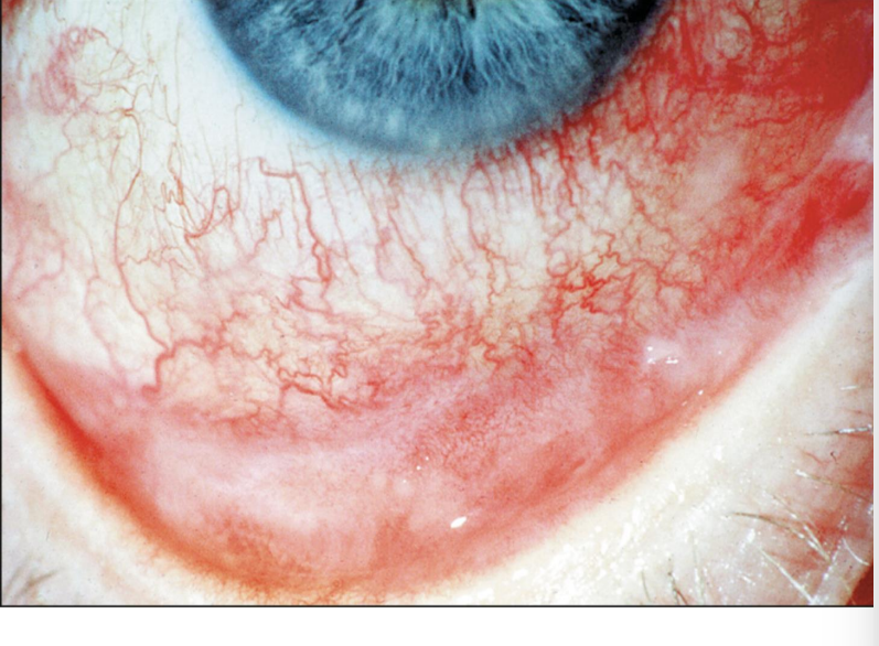 <ol><li><p>• Chronic unilateral conjunctivitis that progresses to bilateral </p></li><li><p><u>• Significant scarring </u></p><ol><li><p>palpebral conj will scar to bulbar conj = <u>symblepharon </u></p></li></ol></li><li><p>• Severe FBS and pain</p></li></ol><p></p>