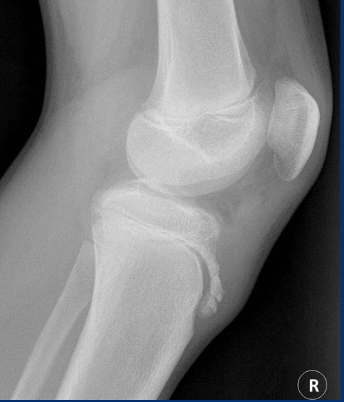 <ul><li><p>ST swelling</p></li><li><p>loss of sharp patellar tendon margins</p></li><li><p>tibial tub fragmentation</p></li></ul><p></p>