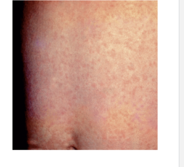 <p><span>Rubella (German Measles) Symptoms</span></p>