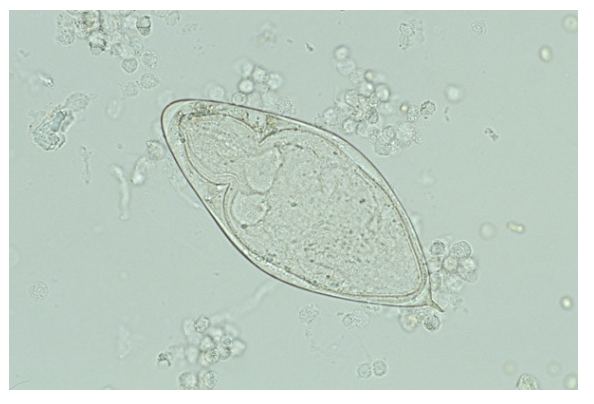 <ul><li><p class=""><strong>Type</strong>: Trematode (fluke)</p></li><li><p class=""><strong>Habitat</strong>: Bladder venous plexus</p></li><li><p class=""><strong>Egg morphology</strong>: Oval with <strong>terminal spine</strong></p></li><li><p class=""><strong>Clinical relevance</strong>:<br>• Associated with <strong>hematuria</strong>, bladder inflammation<br>• Risk factor for <strong>squamous cell carcinoma</strong> of the bladder</p></li><li><p class=""><strong>Diagnosis</strong>: Microscopic ID of eggs in <strong>urine</strong> (not stool)</p><p class=""></p></li></ul><p></p>