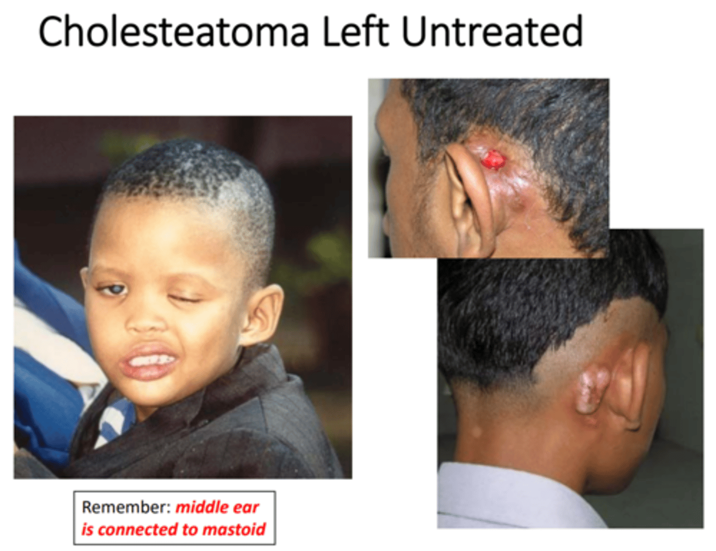 <p>• Benign Tumor = surgery to remove growth completely, &amp; to reconstruct damaged ossicles or eardrum</p><p>• Infected = Requires antibiotics if infection is present </p><p>• Can recur, so patient’s ears should be examined regularly </p><p>• Goal = preserve hearing (and language skills) and equilibrium/balance</p>