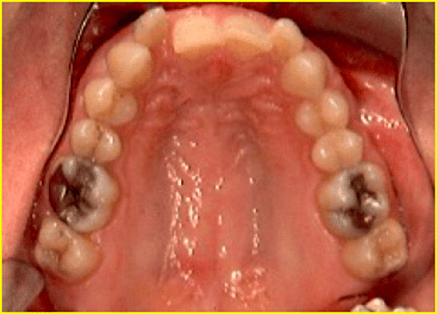 <p>ID the class of occlusion:</p>