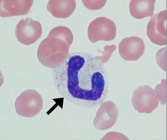 * Lack any nuclear constriction/ segmentation

FXN

* Immature neutrophil released from bone marrow
* Usually seen w marked inflammation