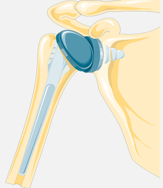 <p>Indications for Total Shoulder Arthroplasty</p>