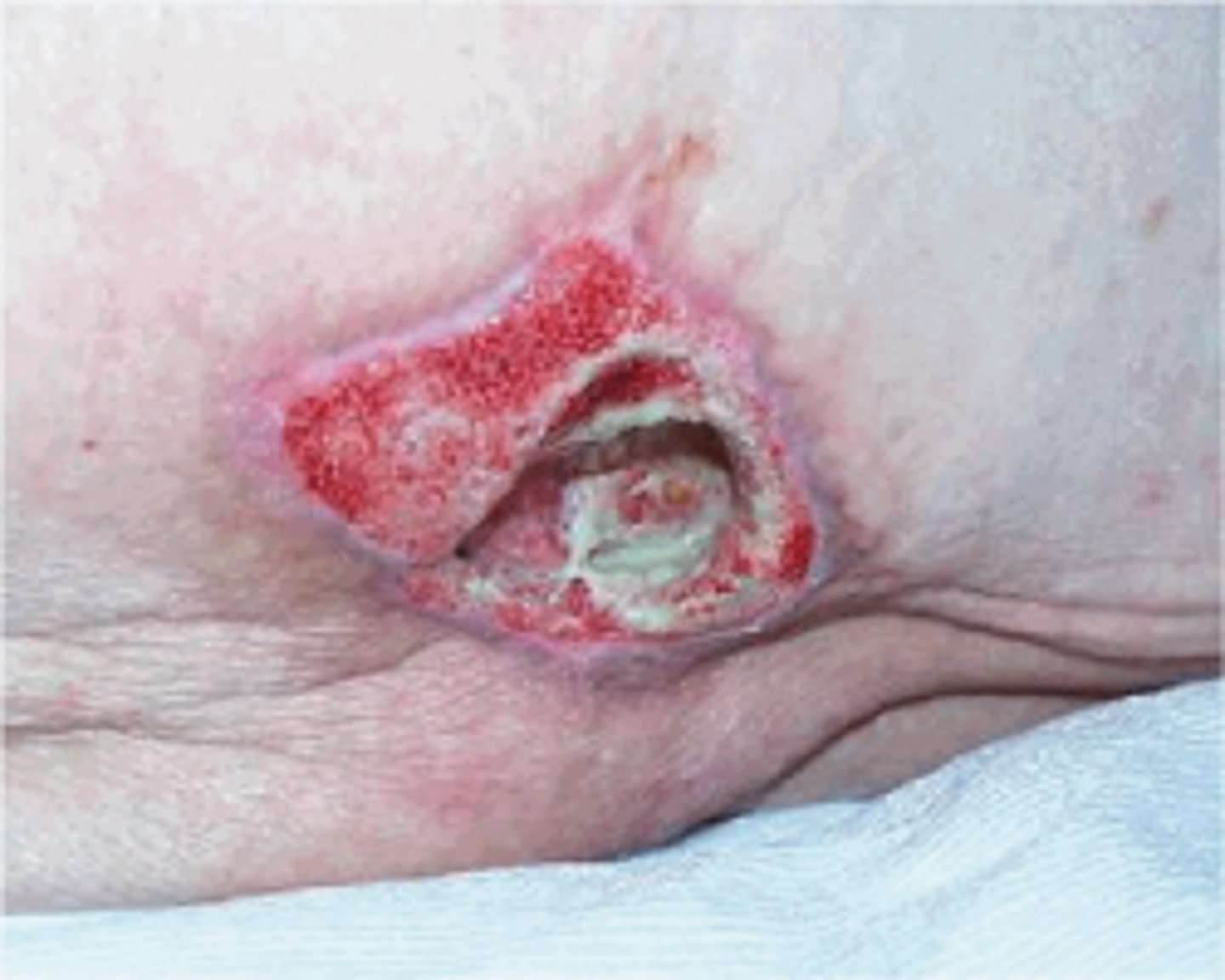 <p>Full-thickness skin loss with destruction, tissue necrosis or damage to underlying muscle, bone or supporting structures</p>