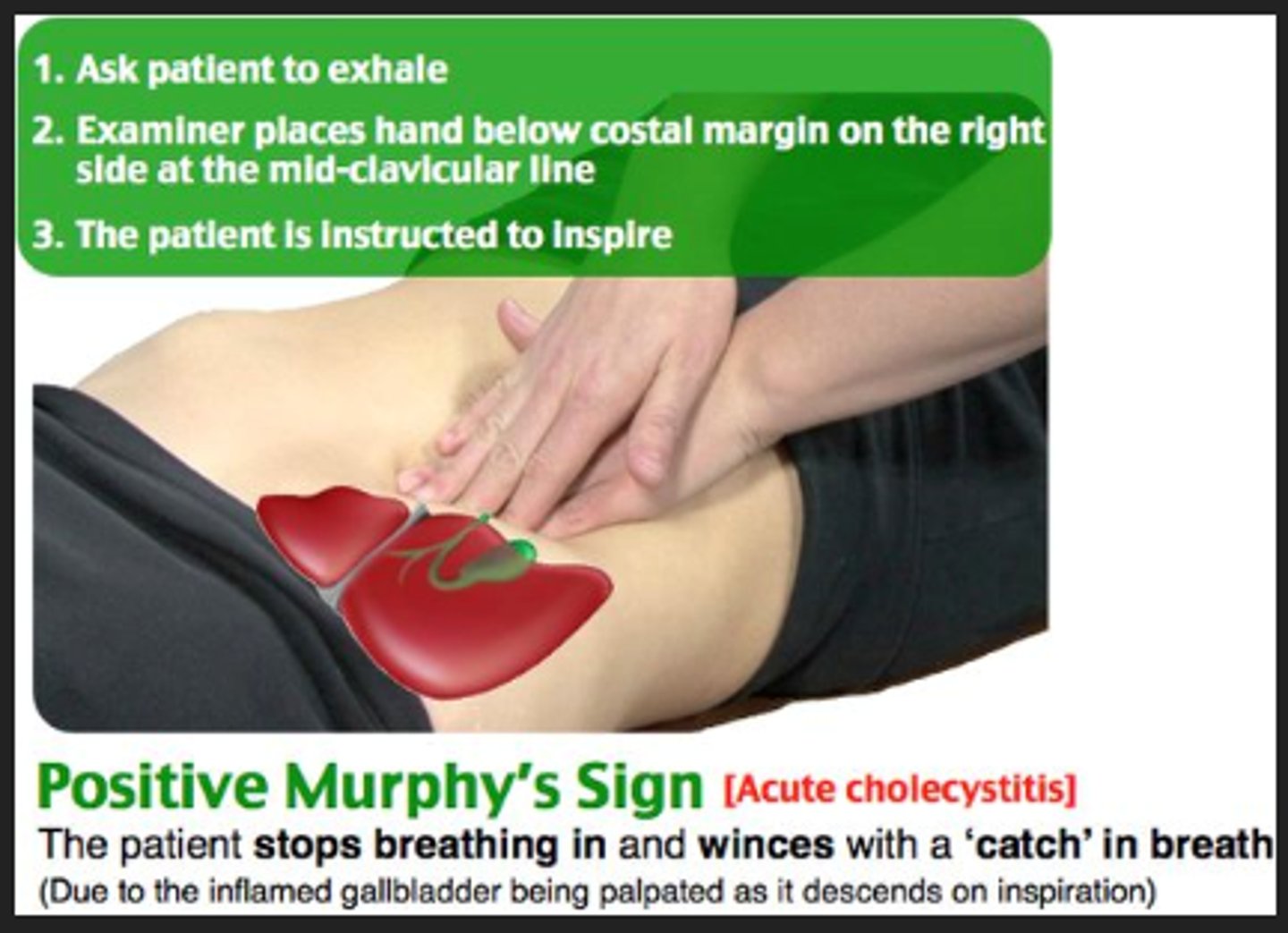 <p>B</p><p>Normally, palpating the liver causes no pain. In a person with inflammation of the gallbladder, or cholecystitis, pain occurs as the descending liver pushes the inflamed gallbladder onto the examining hand during inspiration (Murphy test). The person feels sharp pain and abruptly stops midway during inspiration.</p>