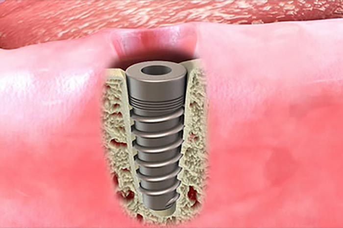 <p>Osseointegration</p>