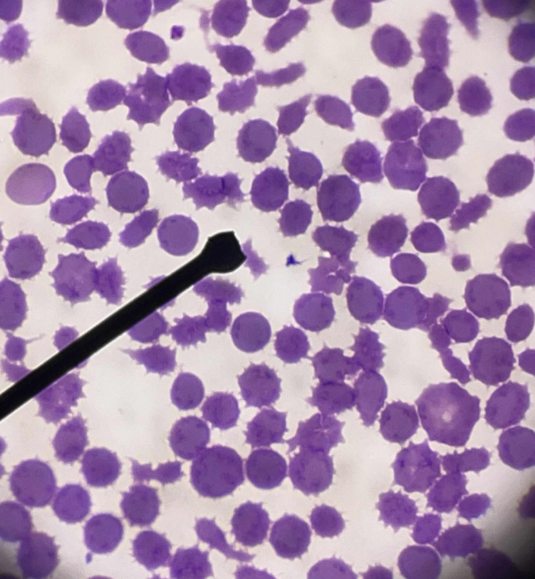 <p>A. Identify the pointed cell</p><p>B. Describe the striking feature</p><p>C. Associated with what condition ?</p><p>D. What is the cause of the cell’s formation?</p>