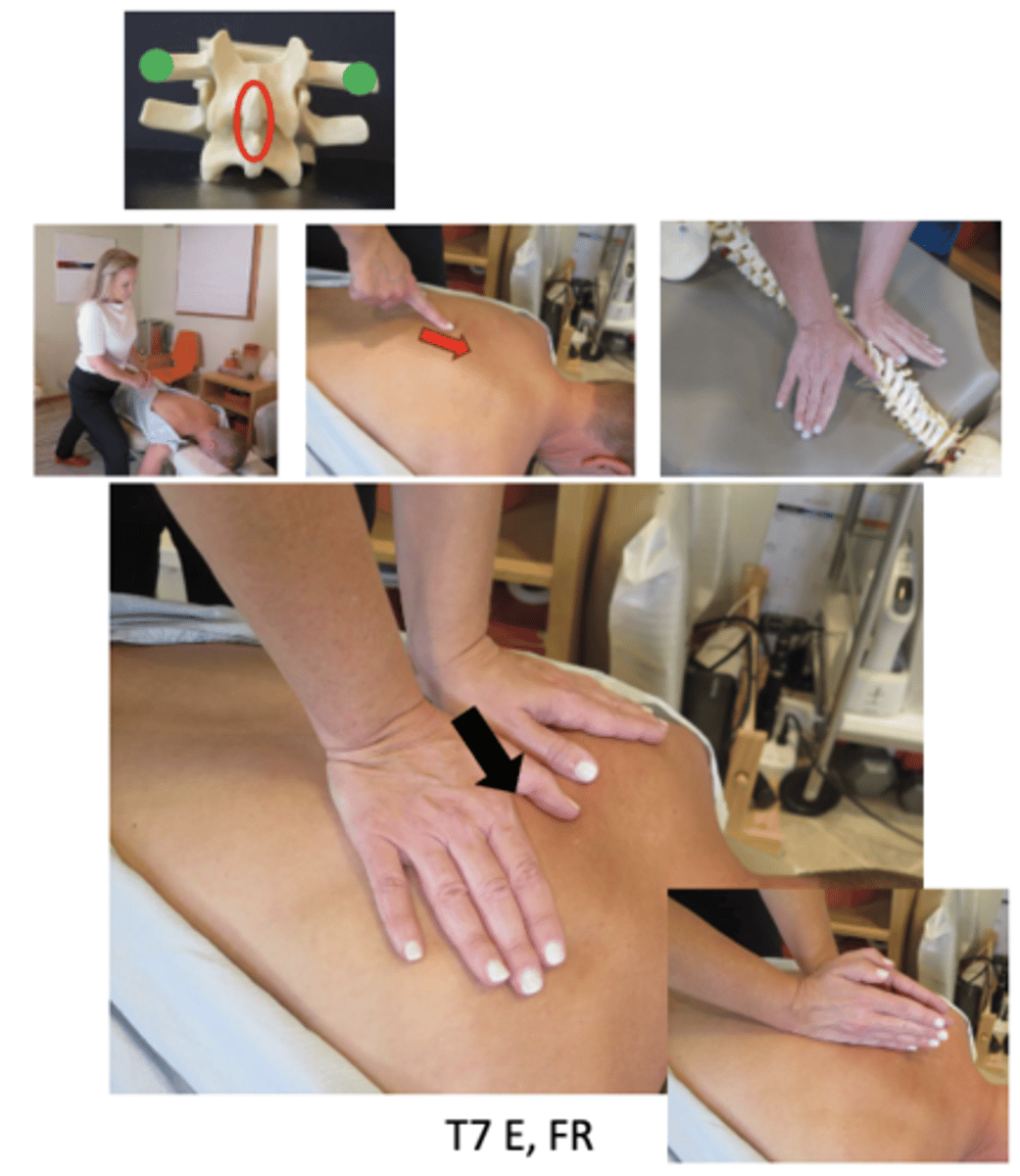 <p>• PP: Prone, asks permission to open gown/contact patient, verbalize finding the segment</p><p>• DP: Modified fencer stance, facing cephalad, thumbs running parallel to the spine, a bolster can be placed under the adjustive contact to flexion preadjustive tension, tissue slack I-S</p><p>• CH: Thenar contact over superior TransverseProcess (TP)</p><p>• IH: Thenar contact over superior TransverseProcess (TP)</p><p>• Vector: P-A and I-S</p><p>**contact can be modified to bilateral hypothenar(knife-edge)</p>
