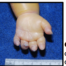 <p>abnormal curvature of 5th digit associated with down syndrome</p>