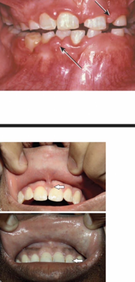 <p>-developmental enamel pitting on facial sapect of anterior dentition</p><p>-multiple fibrous papules predominately in anterior gingiva</p><p>-diffuse fibrous gingival hyperplasia (usually due to anti-seizure meds)</p><p>-+/- radiolucencies of jaws</p>