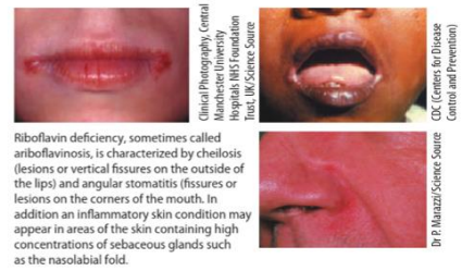 <p>Riboflavin (Vitamin B2) Deficiency: Ariboflavinosis</p>