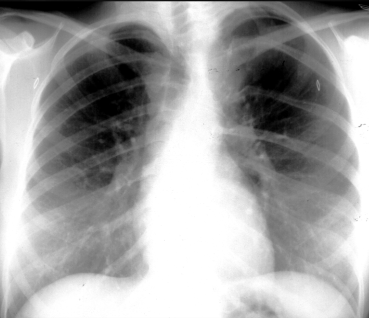 <p>what is seen here for this case of neurofibromatosis type 1?</p>