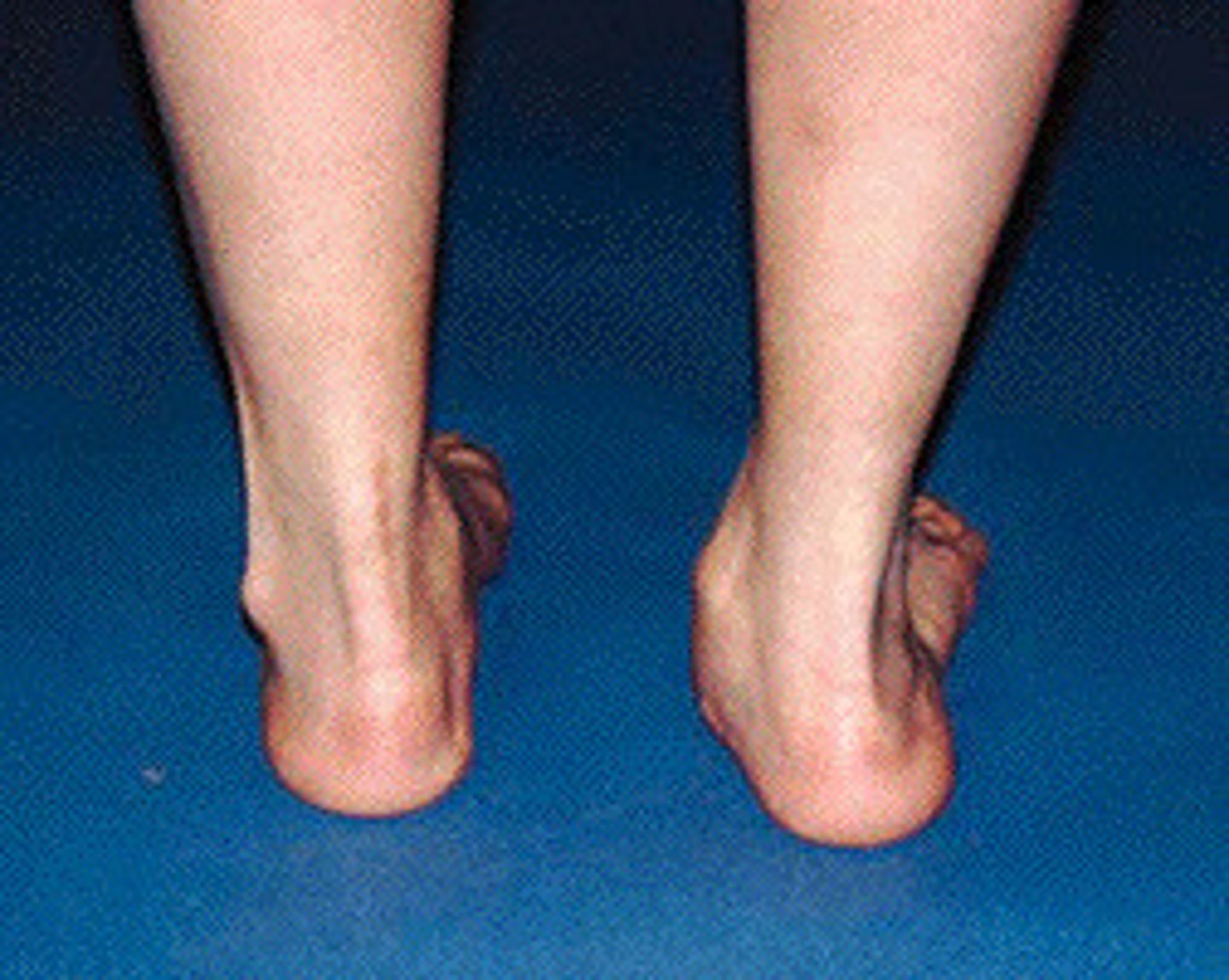 <p>heel of foot</p>