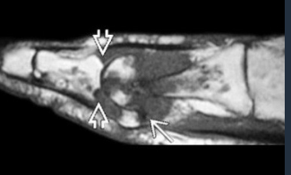 <p>Rx (N in first year)</p><ul><li><p>Cartilage destruction (advanced stage)</p></li><li><p>Tophi</p><ul><li><p>Density, sometimes calcified, eccentric, NOT necessary with neighboring joint changes</p></li><li><p>RARELY intraosseous calcification</p></li></ul></li><li><p>Circumscribed erosions + sclerotic margins</p><ul><li><p>Juxtaarticular, often intraarticular </p></li></ul></li></ul><p>MR</p><ul><li><p>Effusion: hypoT1, hyperT2</p></li><li><p>Edema: soft tissue / bone</p></li><li><p>Tophi: intermediate homogenous T1</p></li><li><p>Synovial panus: hypoT1, hypoT2, peripheral enhancement </p></li></ul><p></p>