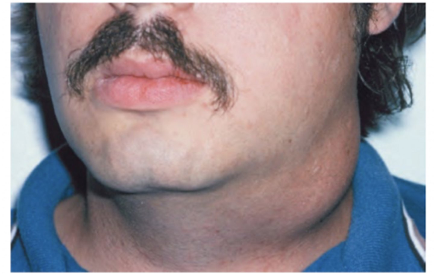 <p>upper lateral</p>