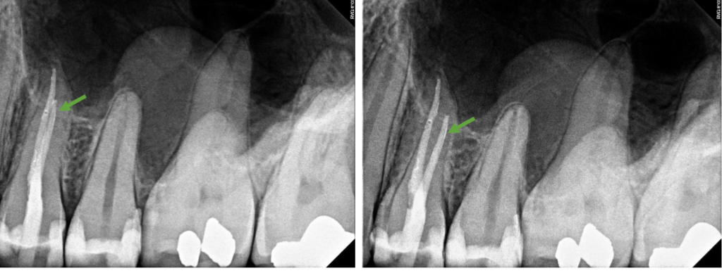 <p>what is the position of the root canal indicated in green </p>