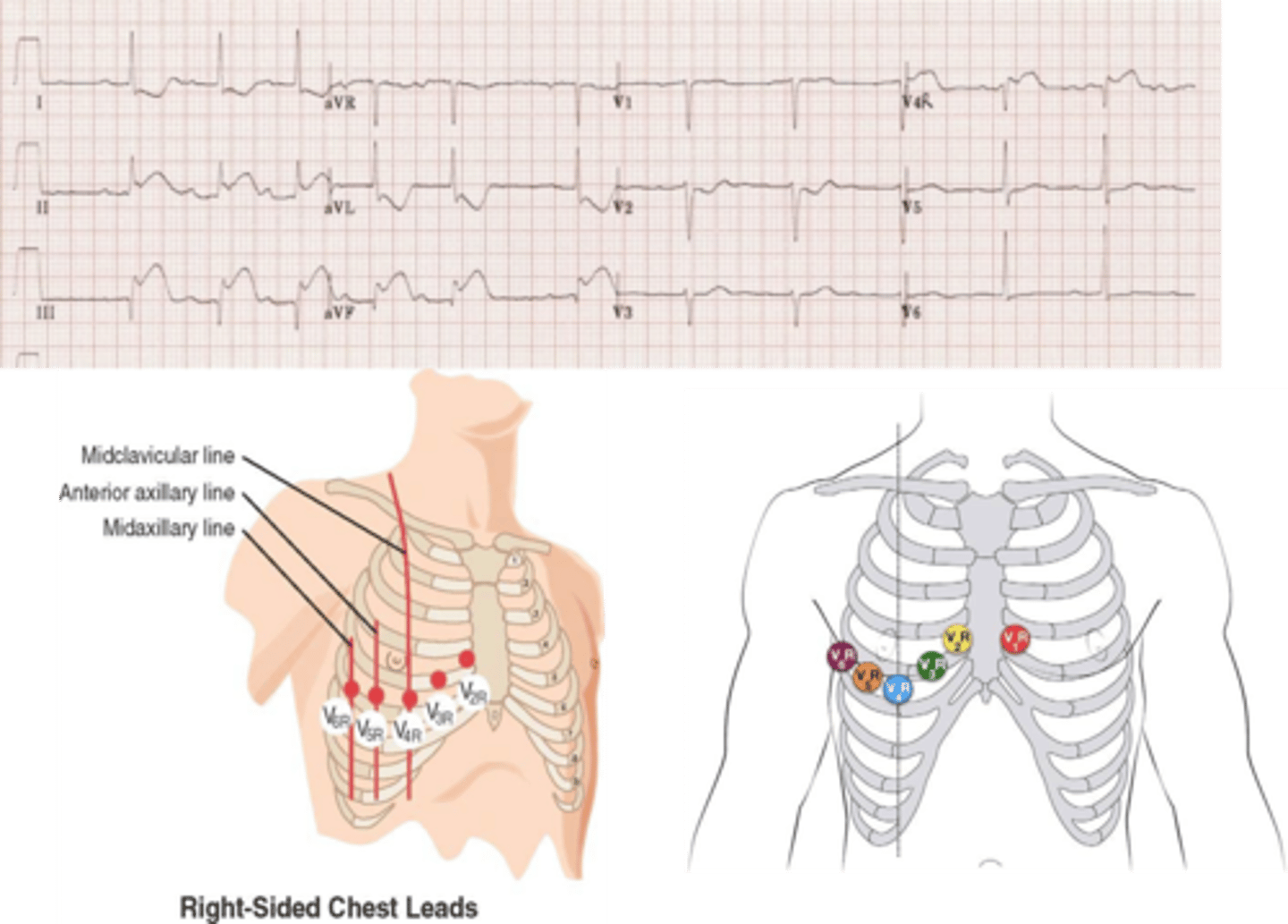 <p>- placed in mirror image on right side of the chest</p><p>- V1 becomes V1R and so on</p>