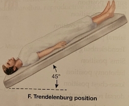 <p>Trendelenburg Position</p>