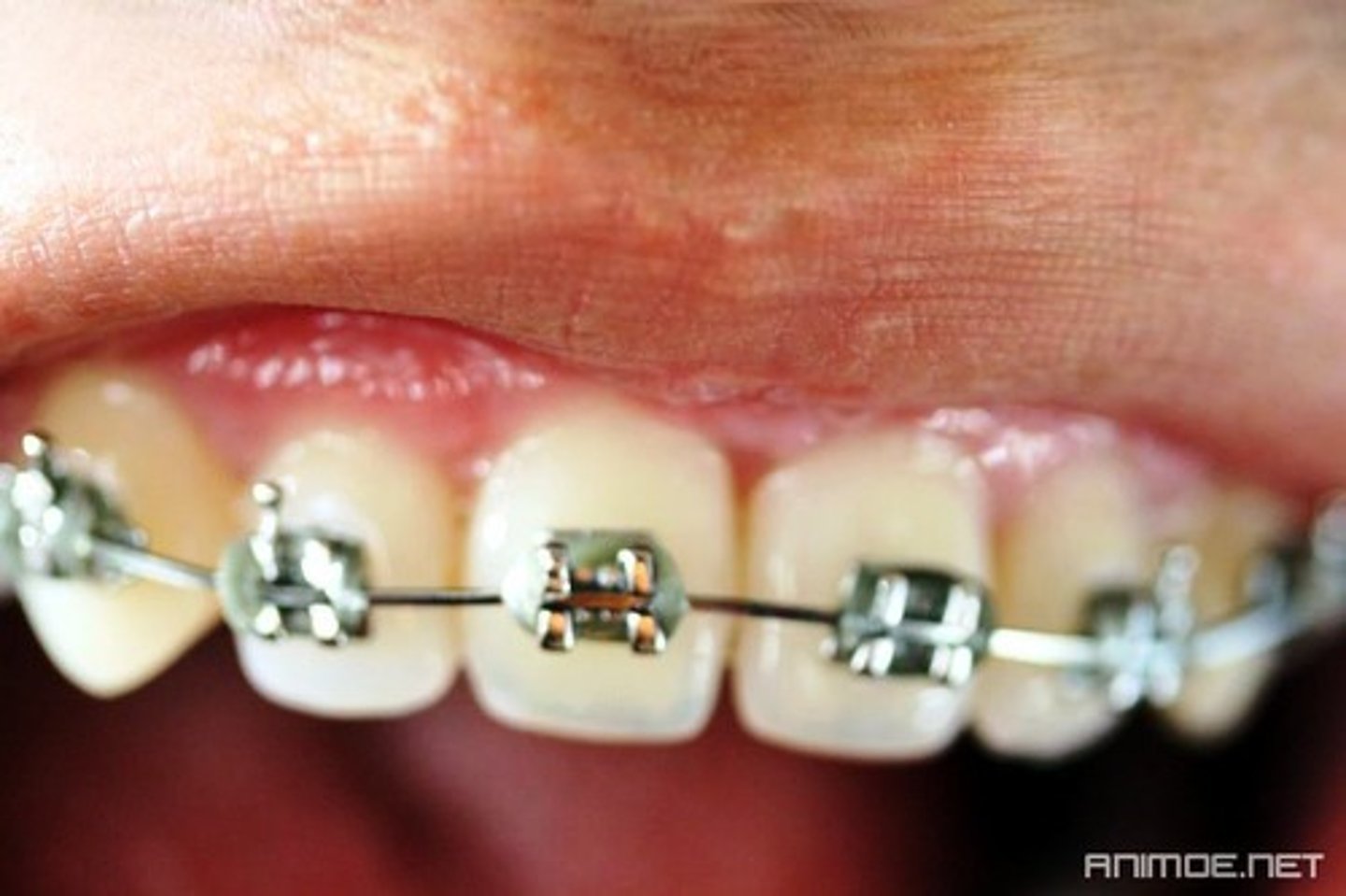 <p>aparatos dentales, frenos, correctores ortodónticos</p>