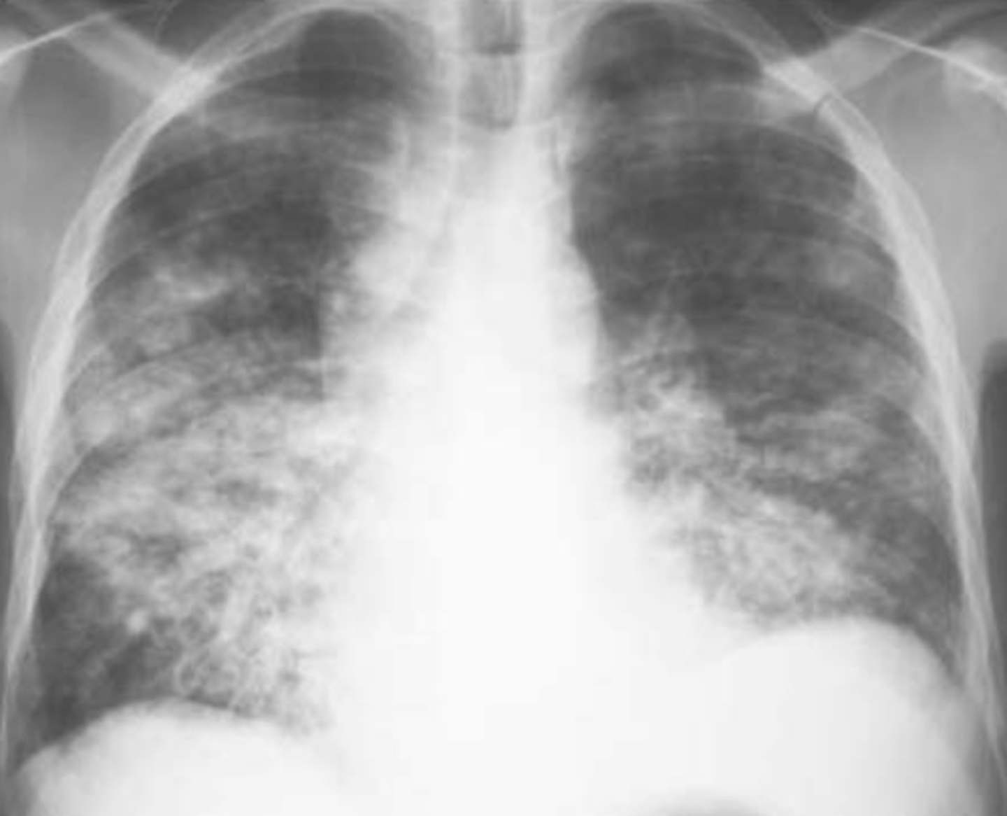 <p>bronchopneumonia</p>