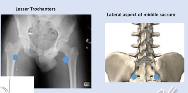 <p>anterior point: lesser trochanters<br>posterior point: lateral aspect of middle sacrum</p>