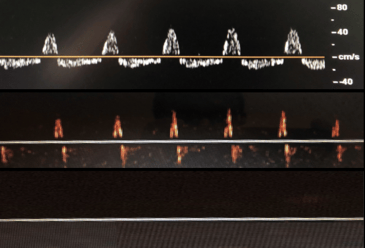 <p>Brain death - ECG criteria must also be met</p><p>Early - low diastolic flow</p><p>Final stage - persistent oscillating high resistance waveforms with no diastolic flow</p>