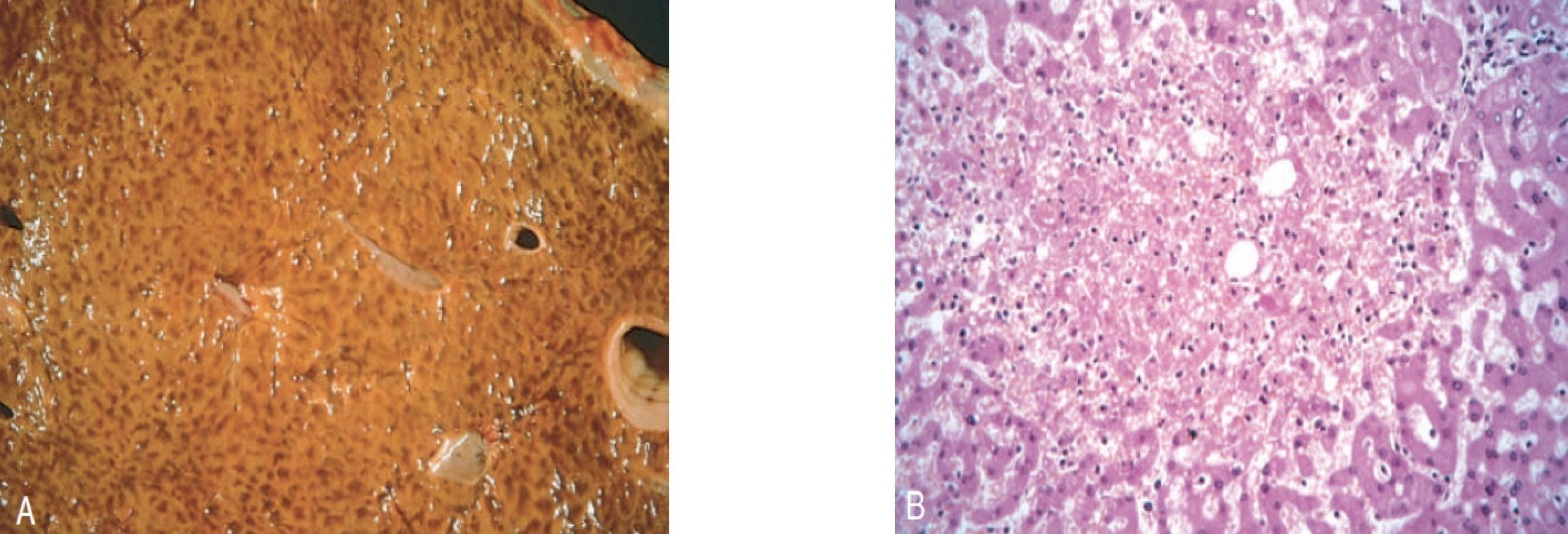 <p><span>1. Describe the gross morphology in A? <br>2. Describe the microscopic morphology in B? </span></p><p><span>3. Identify the condition. </span></p>