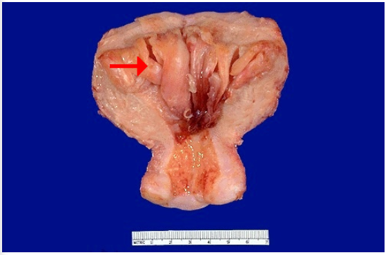 <ol><li><p>Identify</p></li><li><p>What caused this cellular adaptation?</p></li><li><p>What may the patient experience?</p></li></ol><p></p>