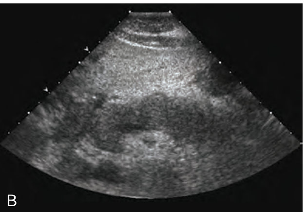 <p>When _____ does occur in _____ pancreatitis, the sonographic appearance of the gland becomes hypoechoic to anechoic and is less echogenic than the liver </p>