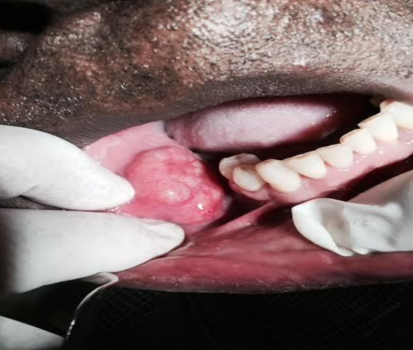 <p>Malignant Salivary Gland Tumors: </p><p>-Slowly growing mass</p><p>-Middle-aged females</p><p>-Painful or present with facial paralysis</p><p>-50% occur in minor glands (palate= most common)</p>