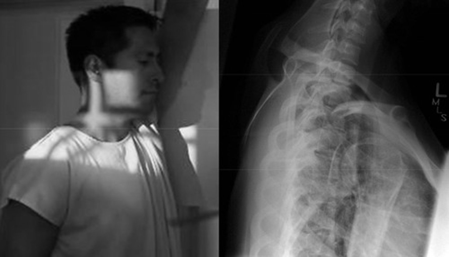 <p>Lower C-spine injury</p>