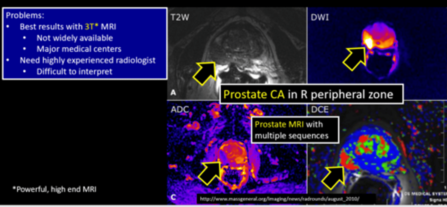 <p>magnetic resonance imaging procedure providing information of anatomic structure and physiology for the staging of prostate cancer It uses a combination of different MRI modalities to better understand the size and extent of prostate tumors.</p>