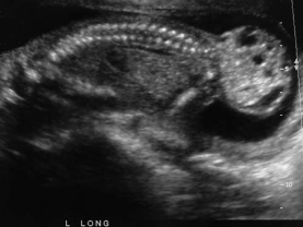 <p><span><span>An asymptomatic patient arrives for a second- trimester fetal surveillance examination. A sagittal image of the fetal body is most suspicious for:</span><strong><span><br></span></strong></span></p><p></p>