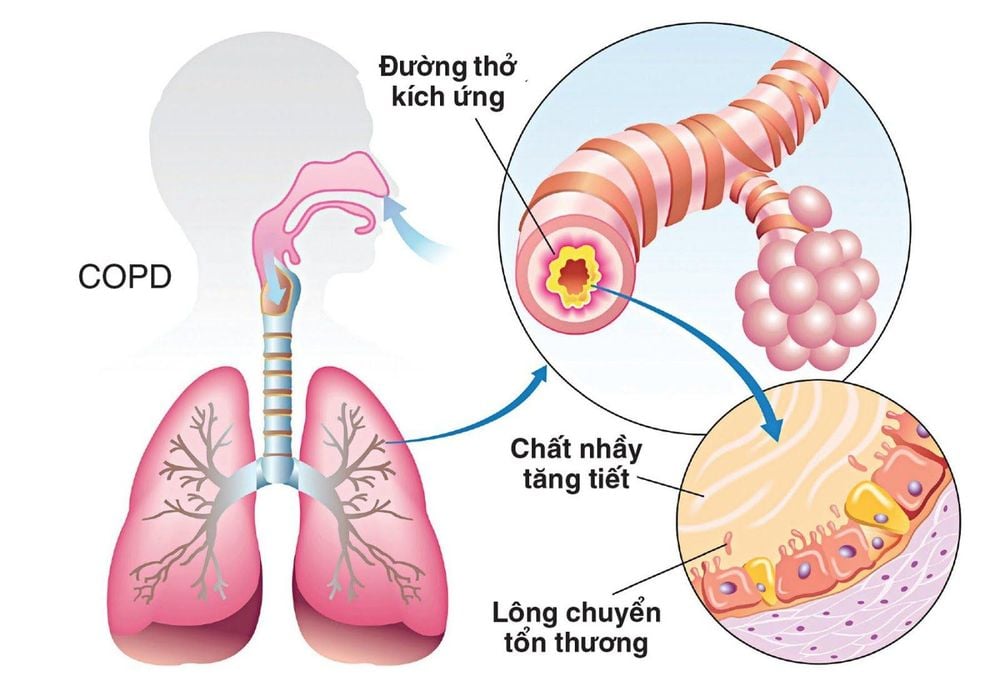 <p>Chronic obstructive pulmonary disease</p>