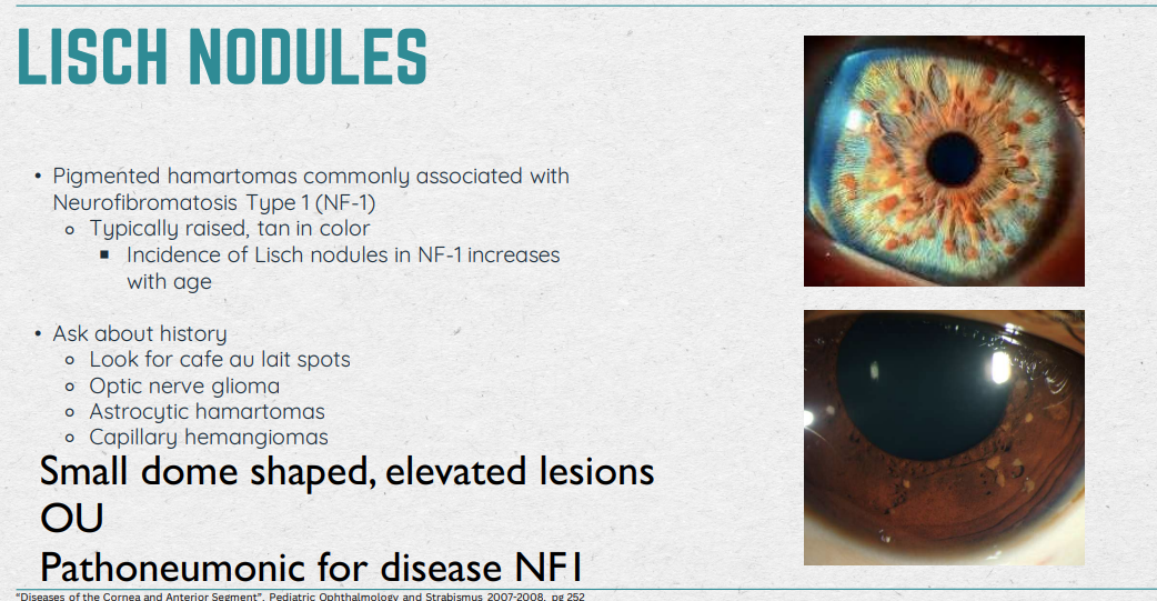 <ul><li><p>Small dome-shaped, elevated lesions</p></li><li><p>OU</p></li><li><p>Pathoneumonic for disease NF-1</p></li></ul><p></p>