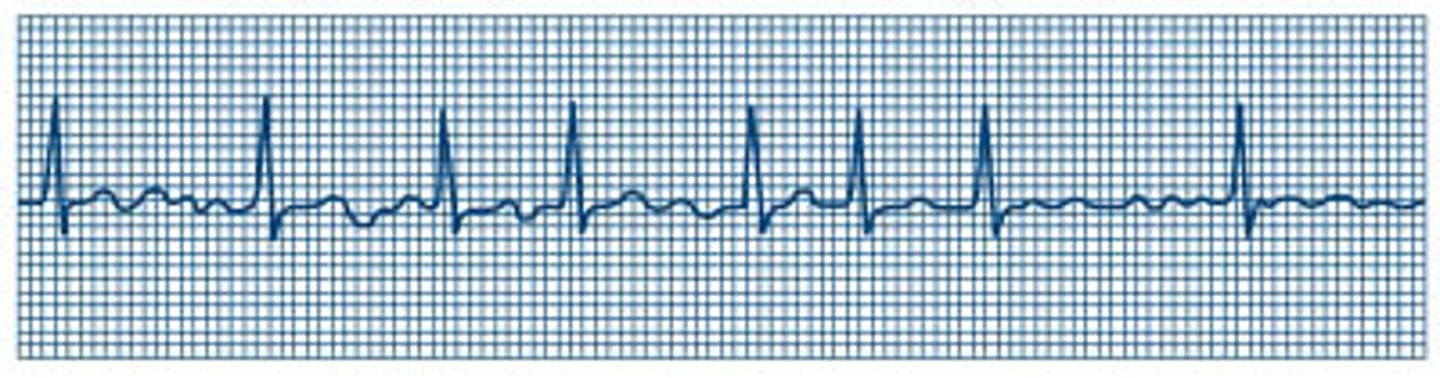 <p>No P wavesCauses: Valve disease, heart failure, Pulm. HTN, COPD, and post heart surgeryTX: Cardioversion after a TTE (rules out clots)-Long term TX: Digoxin always check ATP before giving A: apical pulse T: Toxicity: (max. 2.0) Visual disturbances, anorexia, and N&V, K+ lower than 3.5Anticoagulant: Warfarin/Coumadin (INR) anecdote: Vita K eat moderate green leafy veg b/c they have lots of vita K and we don't want to block the warfarin from working</p>