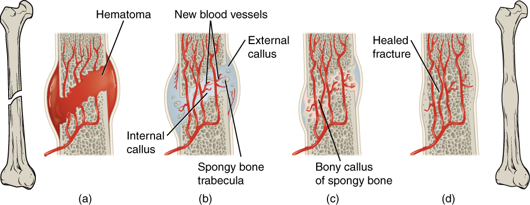 <ul><li><p>the healing of a bone fracture follows a series of progressive steps</p><ul><li><p>a fracture hematoma forms</p><ul><li><p>when a bone breaks, blood flows from any vessel torn by the fracture, the blood begins to clot forming a fracture hematoma</p></li><li><p>the disruption of blood flow to the bone results in the death of bone cells around the fracture</p></li></ul></li><li><p>internal and external callus form</p><ul><li><p>within 48 hours after the fracture, chondrocytes from the endosteum have created an internal callus by secreting a fibrocartilaginous matrix between the two ends of the broken bone</p></li><li><p>periosteal chondrocytes and osteoblasts create and external callus of hyaline cartilage and bone, respectively, around the outside of the break</p></li><li><p>this stabilizes the fracture</p></li></ul></li><li><p>cartilage of the callus is replaced by trabecular bone</p><ul><li><p>eventually internal and external calli unite, compact bone replaces spongy bone at the outer margins of the fracture, and healing is complete</p></li></ul></li><li><p>remodeling occurs</p></li></ul></li></ul><p></p>