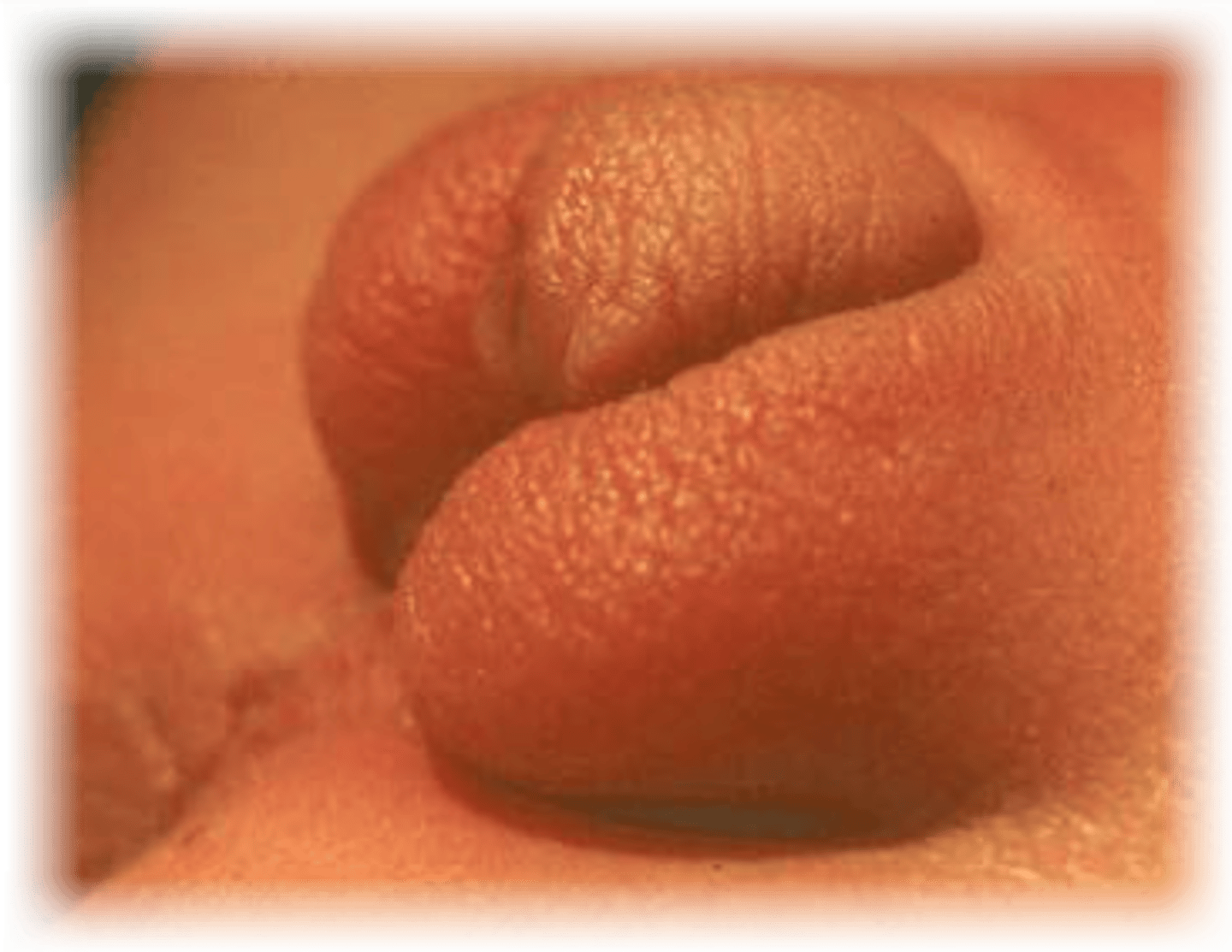 <p>a cleft or split in the midline of the scrotum, appearing as two separate scrotal halves</p>