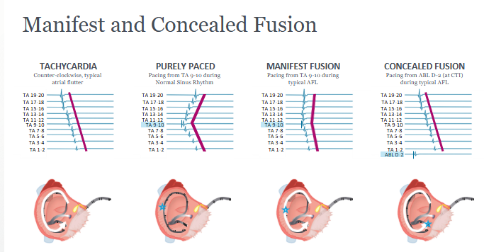 <ol><li><p>Atrial signals are linear, from proximal to distal TA electrodes</p></li><li><p>Chevron atrial signals when paced from middle electrodes during NSR</p></li><li><p>Pacing from middle electrodes during typical AFL, slight chevron + slight linear = fusion</p></li><li><p>Pacing from distal catheter at CTI line, a place of low conduction, during typical AFL</p></li></ol><p></p>