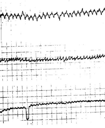 <p>Congenitale nystagmus of infantiele nystagmus</p><ul><li><p>Excentrieke oogbewegingen waar patiënt zelf geen<br>last van ondervindt</p></li><li><p>Nystagmus is bijnaaltijd horizontaal of rotatoir, maar <br>zeer onregelmatig</p><ul><li><p>Omni -of bidirectioneel, onverwachte omkering</p></li></ul></li><li><p>Nystagmus bij opwaartse gaze is virtueelaltijd horizontaal, niet verticaal</p></li><li><p>Convergentie: nystagmus daalt (vinger volgen naar jezelf toe)</p></li><li><p>&nbsp;Divergentie: nystagmus stijgt (vinger volgen van jezelf weg)</p></li><li><p>Null point: dode zone (een punt waar nystagmus weg is)</p></li><li><p>Oorzaak: visuele of oculomotore<br>abnormaliteit</p></li></ul><p></p>
