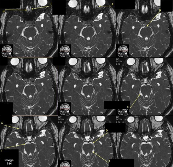<p>Letter H in Image 184 is pointing to which cranial nerve?</p>