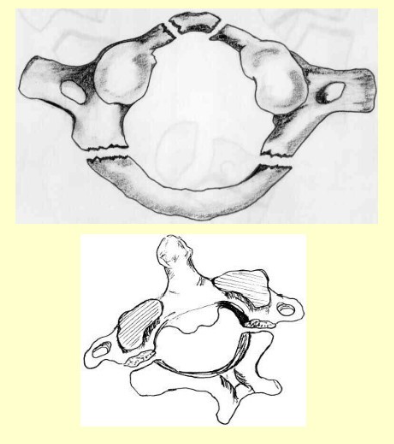 <p>burst/Jefferson fracture- C1 breaks into 4 pieces </p><p>Hangman’s fracture- C2 breaks into 2 pieces, due to hyperextension of the head on the neck (hanging) </p>