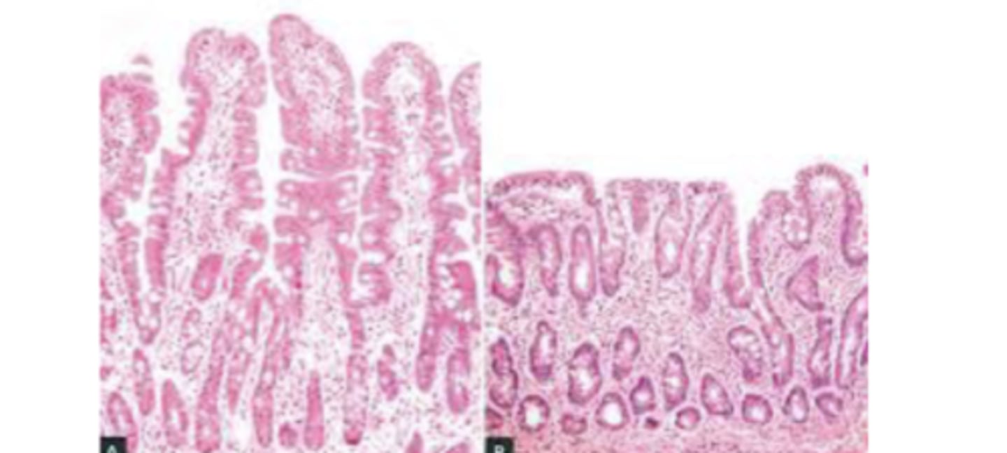 <p>gluten sensitive enteropathy; immune-mediated reaction against gluten</p><p>*blunting of villi &amp; loss of surface area</p>