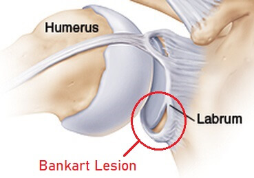 <p>tear in glenoid labrum, the cartilage rim surrounding shoulder socket; primarily caused by traumatic shoudler dislocation, esp anterior dislocation;</p><p></p>