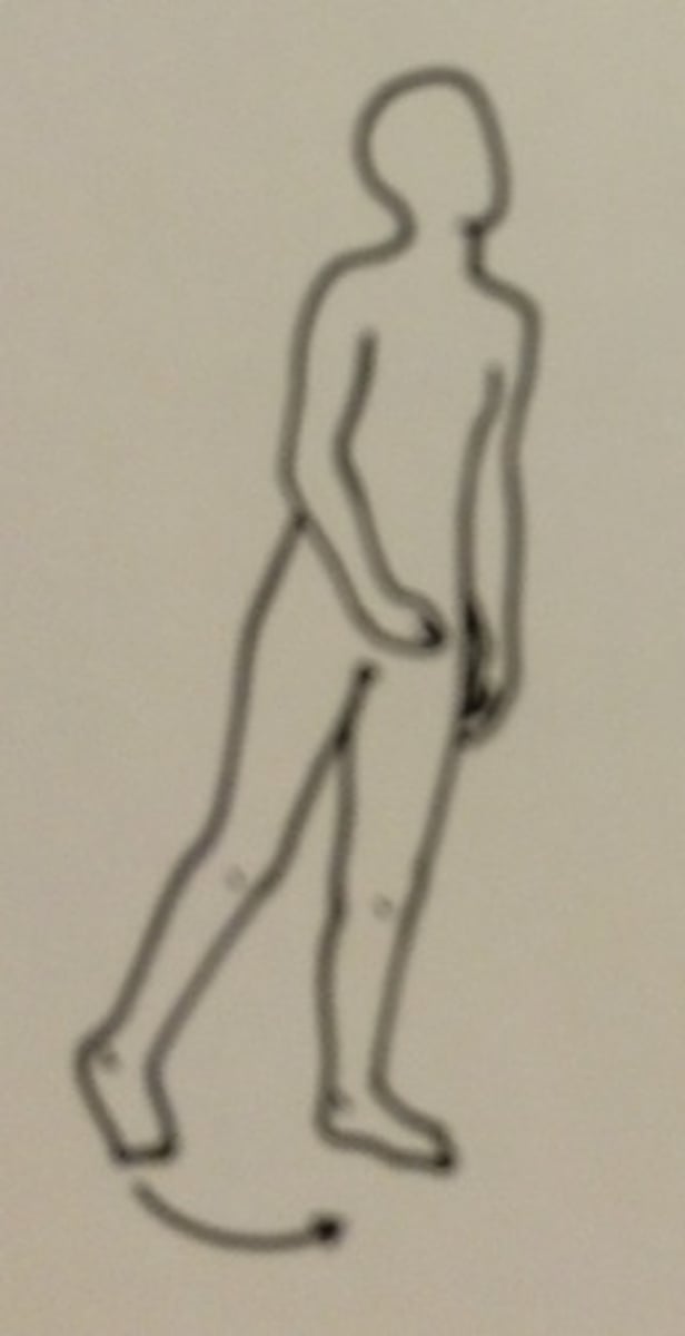 <p>arm is held close to body while patient drags foot</p><p>seen with lesions of upper motor neurons</p>